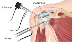Arthroscopy Devices and Disposables Market