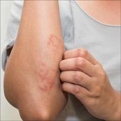 Atopic Eczema Treatment Market